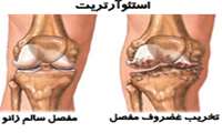 اگر مبتلا به استئوآرتریت (آرتروز) هستید مصرف سیب زمینی و پیاز را محدود کنید